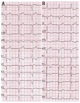 Successful radiofrequency catheter ablation of Wolff-Parkinson-White syndrome in a patient with dextrocardia: A case report